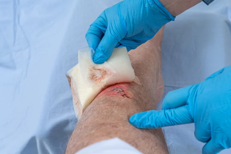 Stitches Healing Stages: Holding Healing Together