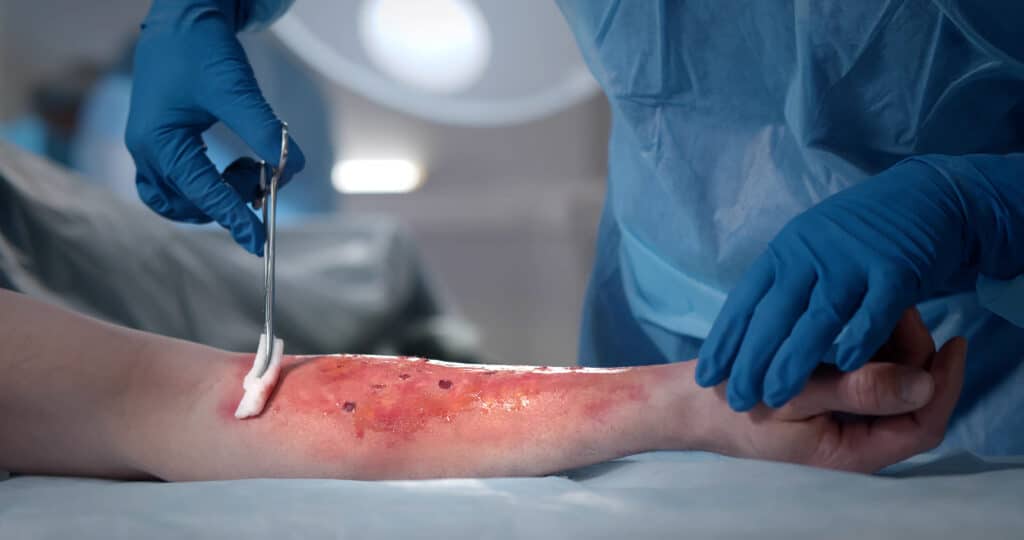 A practitioner performs debridement and uses irrigation & debridement cpt codes