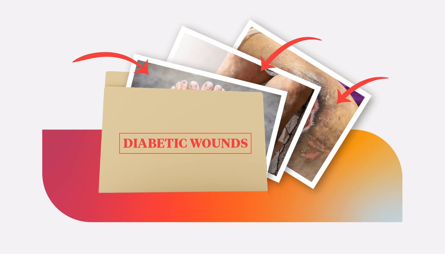 Types of Diabetic Wounds Providers Should Know