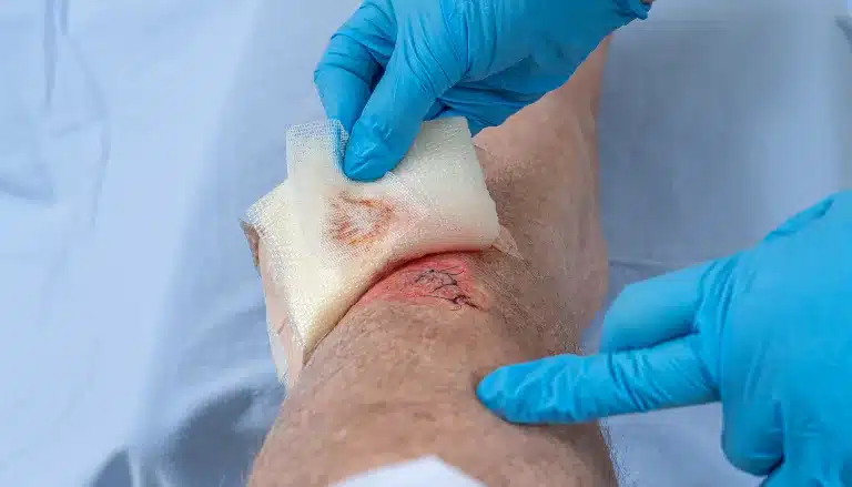 Healthy vs. Infected Wounds: A Clinician’s Guide